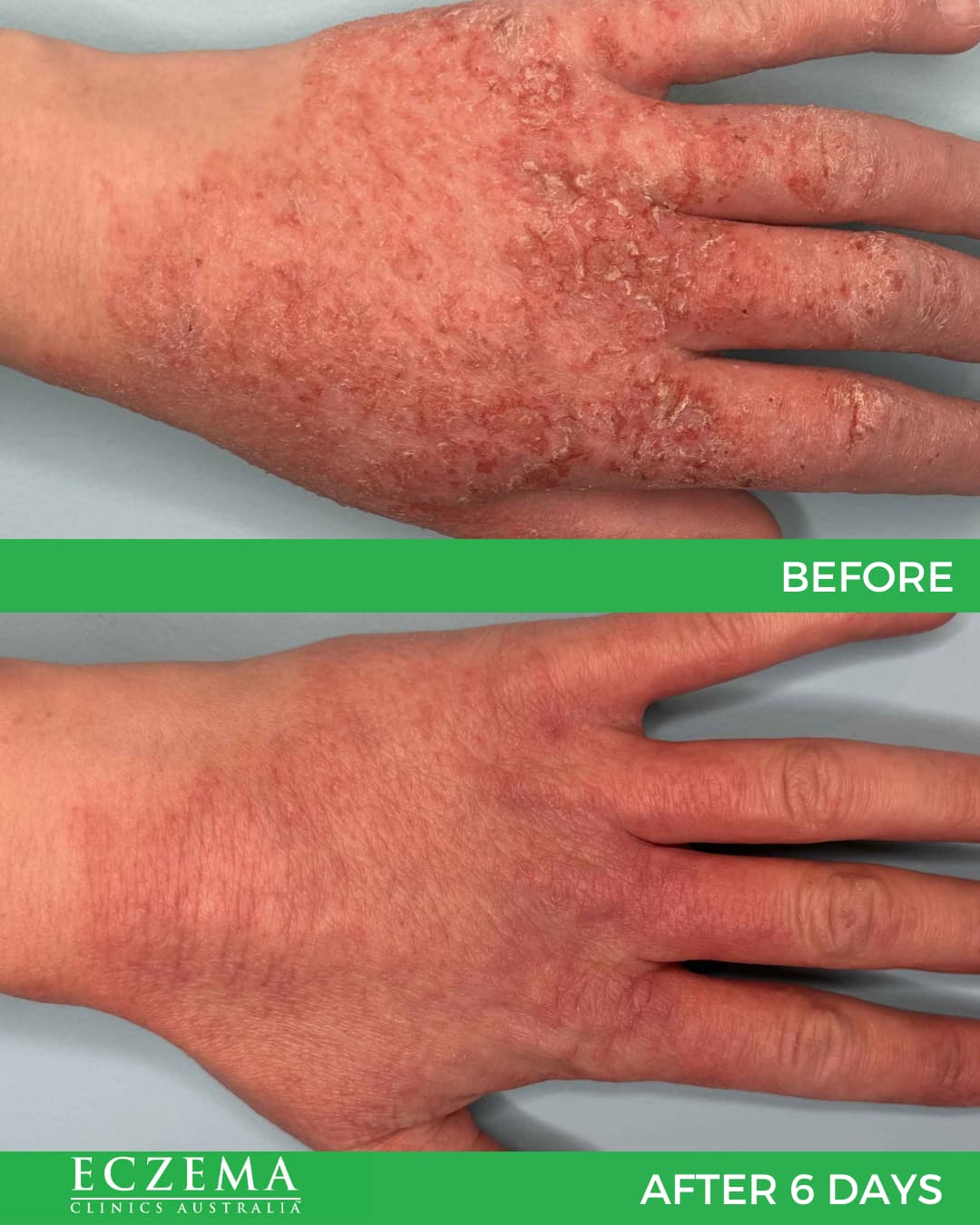 Eczema