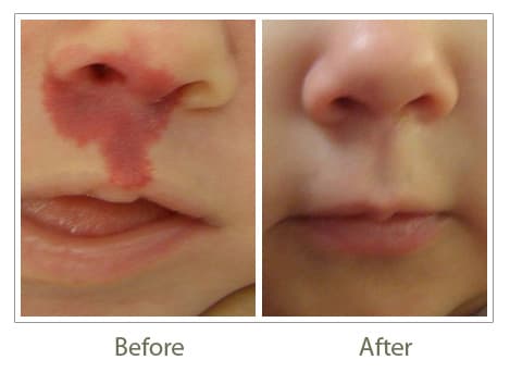 Paediatric Dermatology
