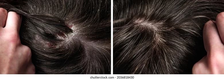 Seborrheic Dermatitis (Dandruff)