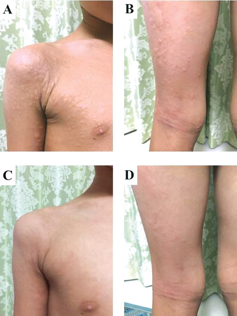 Urticaria