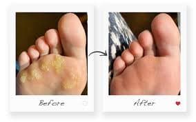 Wart Treatment