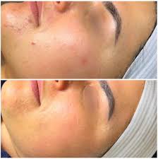 Microneedling PRP for Acne Scars